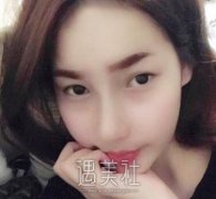 河北省人民医院李彦荣双眼皮怎么样？有案例吗？ width=