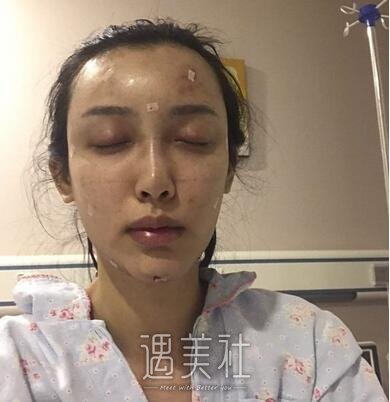 鲁树荣,脂肪填充