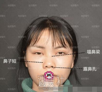 李劲良,隆鼻