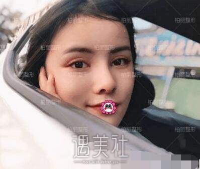 李劲良,隆鼻