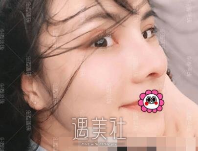 李劲良,隆鼻