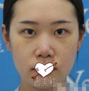 合肥安医一附曹东升隆鼻案例：果也太惊艳了叭 width=