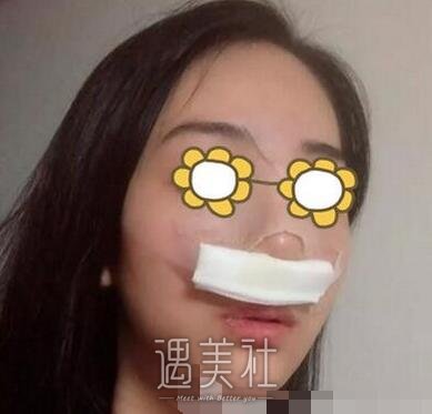 长沙,南湖,隆鼻