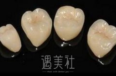 钴铬烤瓷牙的价格到底是多少?请别再支支吾吾! width=