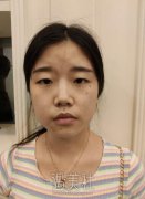 交大一附院整形科做双眼皮怎么样?有案例吗? width=