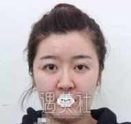 取颊脂垫前后对比照片|取颊脂垫恢复记录日记呈现~ width=