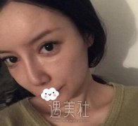 耳软骨垫鼻尖前后图片分享|耳软骨垫鼻尖恢复过程记录~ width=