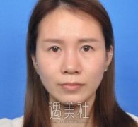 林晓曦隆鼻手术案例：隆鼻要自然才是真理~ width=