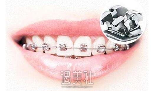 厦门牙齿矫正价格是多少?影响因素都有哪些?