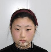银海医美何军双眼皮案例：十五天后基本自然! width=