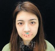 双眼皮术后恢复过程图|双眼皮术后一个月记录~ width=