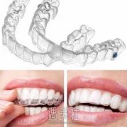隐适美牙套多少钱?能有矫正牙齿吗? width=