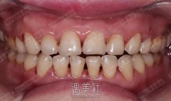 烤瓷牙修复前后图片|烤瓷牙修复案例分享~ width=