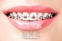 正畸牙齿的价格大概多少？有哪些影响因素喃？ width=