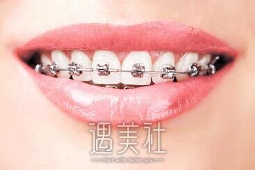 正畸牙齿
