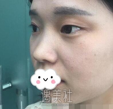 刘辅蓉,双眼皮