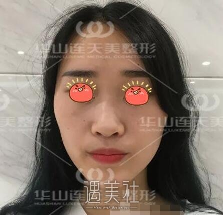 杭州,华山连天美,刘军,隆鼻