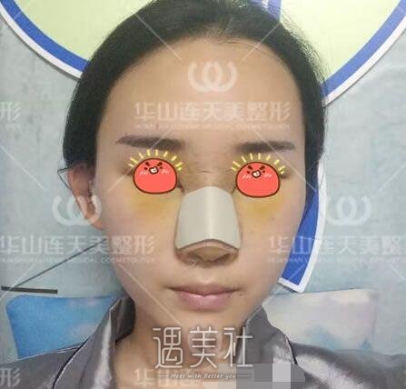 杭州,华山连天美,刘军,隆鼻