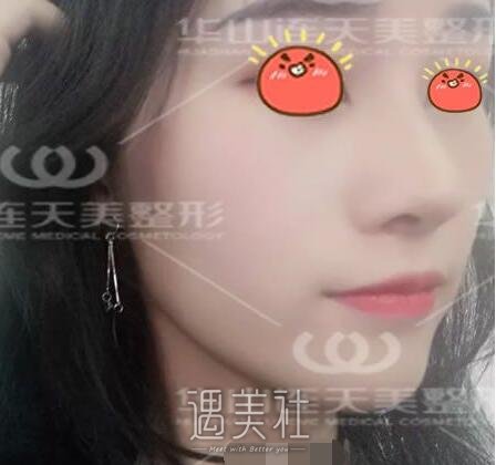 杭州,华山连天美,刘军,隆鼻