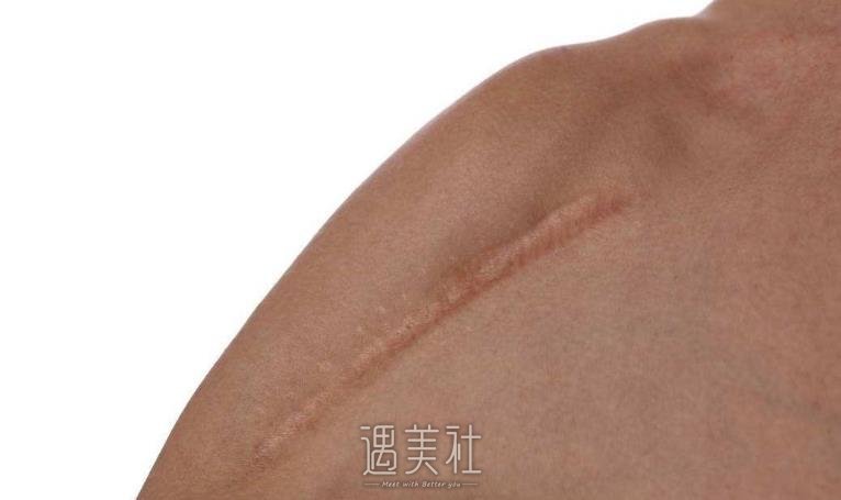 南方医院疤痕修复价格大概多少?贵不贵喃?