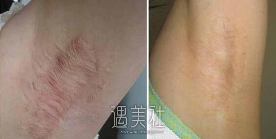 南方医院疤痕修复价格大概多少?贵不贵喃?