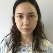 刘武林双眼皮案例：闺蜜看了都羡慕的要死! width=