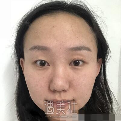 陈文,双眼皮