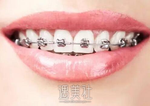 北京,圣贝,正畸