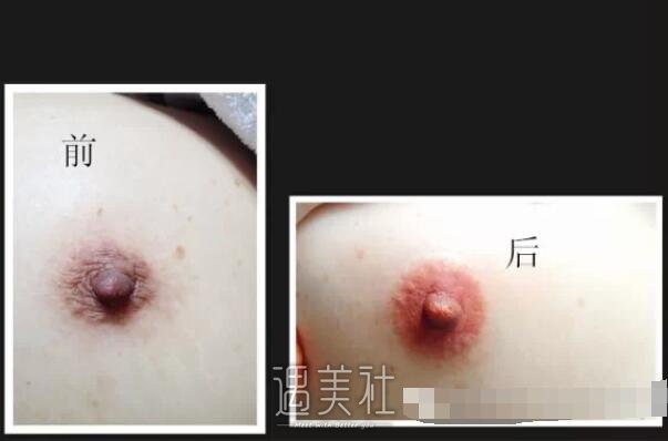 乳晕漂红对比照片|乳晕漂红案例硬核来袭~