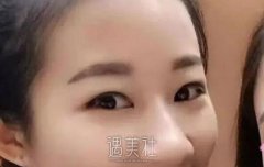 双眼皮术后恢复过程图|双眼皮术后详细记录~ width=