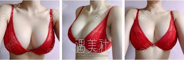 假体隆胸