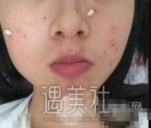 激光点痦子恢复过程图|激光点痦子日记分享哦~ width=