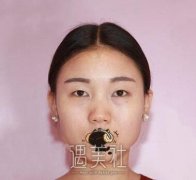 邵阳市中心医院整形科割双眼皮怎么样？有案例吗？ width=