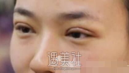 九院,朱惠敏,双眼皮