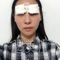 张卓男医生双眼皮技术真的很6?真实案例一览~