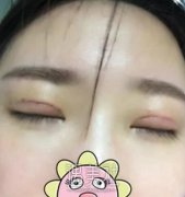 重庆西南美容整形科双眼皮过程分享：靠谱的三甲医院~ width=