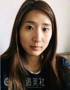 深圳北大医院李天石双眼皮案例：一次不一样的体验~ width=