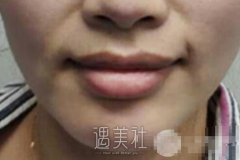 玻尿酸丰唇珠前后比照|玻尿酸丰唇珠案例记录~ width=