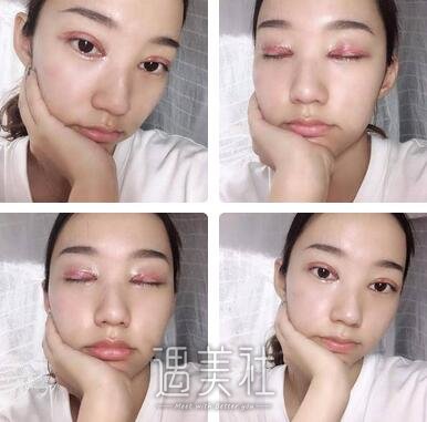 省二院,张卓男,修复双眼皮