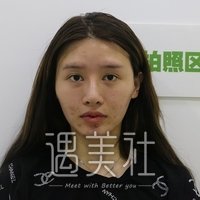蔡仁祥双眼皮案例分享，恢复果图展示~