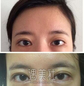 杨亚益双眼皮修复做得怎么样?真实案例一览~