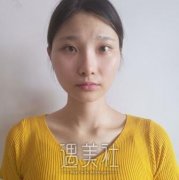 河北二院整形科价格表：面部吸脂瘦脸初体验~ width=