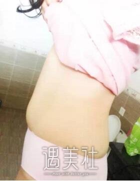 杭州静港程卫民吸脂果好不好?看看我的真实案例吧!