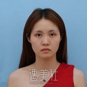 罗汇东鼻子做得好吗?有近期隆鼻案例吗? width=