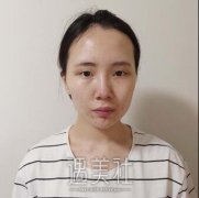 达县中心医院可以做双眼皮吗?有案例吗? width=