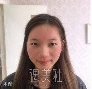 双眼皮隆鼻一起做经历：朋友说果很惊艳  width=
