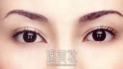 帕克双眼皮一般在多少钱？想了解下~ width=