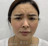 额头太阳穴填充脂肪后形态异常、太饱满能修复吗？ width=