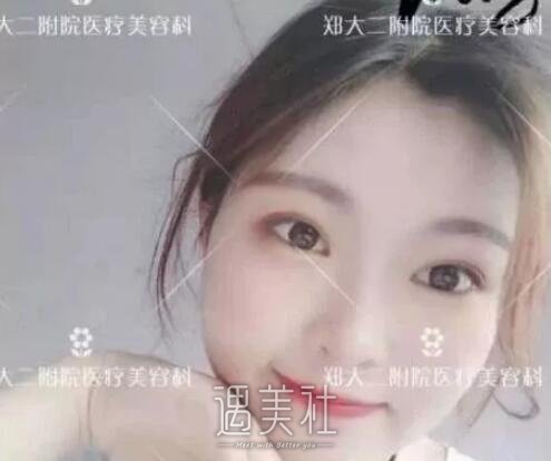 郑大五附院整形科割双眼皮怎么样?有相关案例吗?