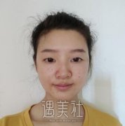 大同三医院整形科价目表：王亚荣双眼皮真实对比图案例分享~ width=